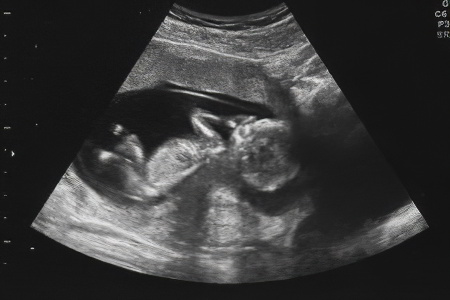 Скрининг второго триместра Скрининг второго триместра