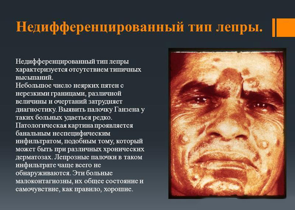 Лепра диморфного и недифференцированного типа Лепра диморфного и недифференцированного типа