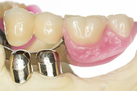 Способы фиксации коронки Способы фиксации коронки