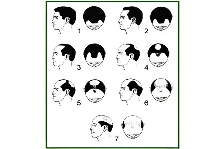 Стадии облысения Стадии облысения