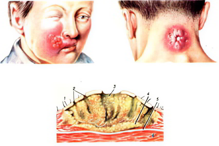 Стадии и локализации карбункула Стадии и локализации карбункула