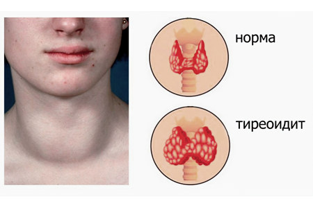 тиреоидит тиреоидит