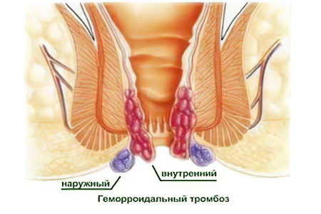 Тромбоз Тромбоз