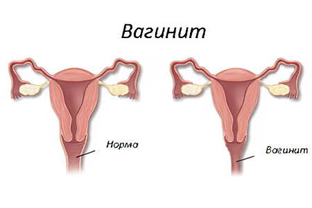 вагинит вагинит