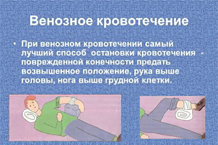 Венозное кровотечение Венозное кровотечение