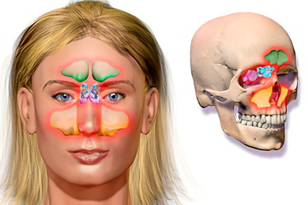 Виды фронтита Виды фронтита