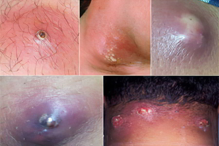 Виды карбункулов Виды карбункулов