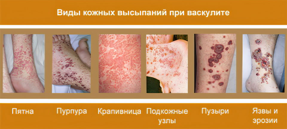 виды васкулита виды васкулита