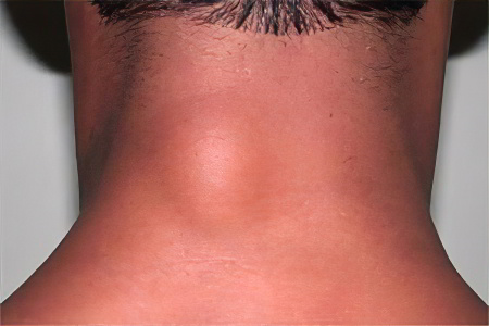 Виды липомы Виды липомы