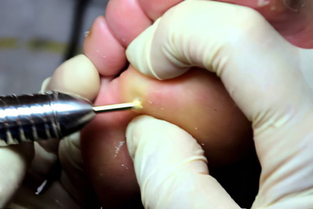 Высверливание стержневой мозоли Высверливание стержневой мозоли