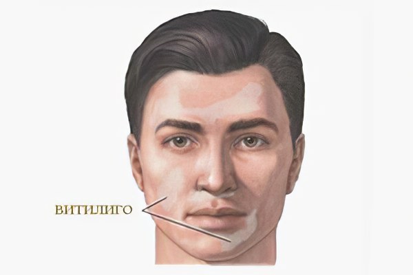 Витилиго Витилиго