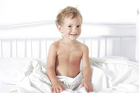 Витилиго Витилиго