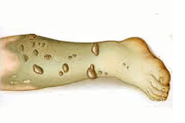 Влажная гангрена Влажная гангрена