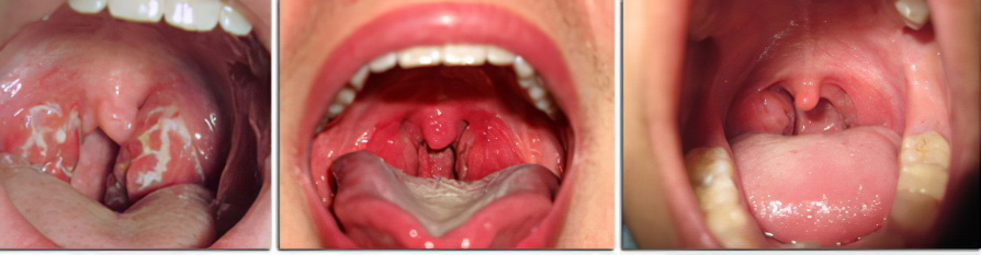 Миндалины Миндалины