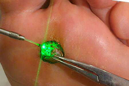 Удаление стержневой мозоли Удаление стержневой мозоли