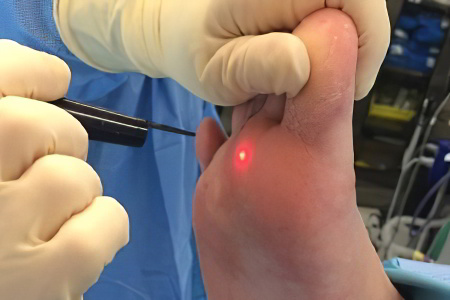 Удаление мозолей лазером Удаление мозолей лазером