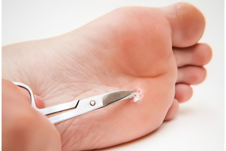 Как удалить подошвеную бородавку Как удалить подошвеную бородавку