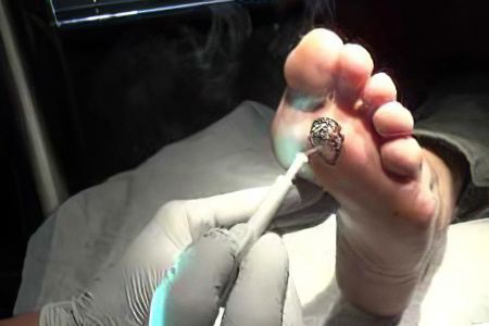 Удаление стержневых мозолей Удаление стержневых мозолей