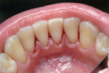 Удаление зубного налёта Удаление зубного налёта