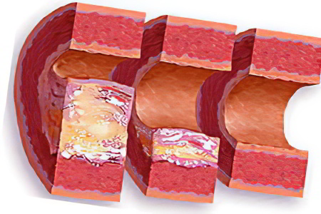 Уплотнение аорты Уплотнение аорты