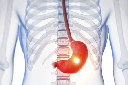 Заболевания гастродуоденальной области Заболевания гастродуоденальной области