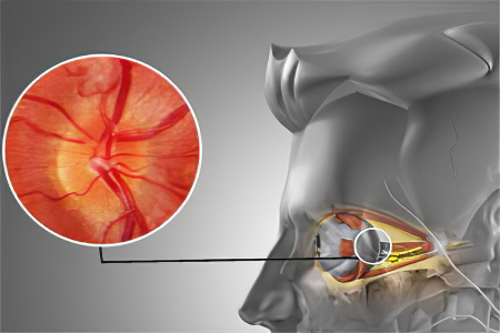 Причины неврита Причины неврита