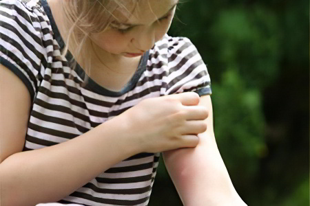 Зуд от укуса мошки Зуд от укуса мошки